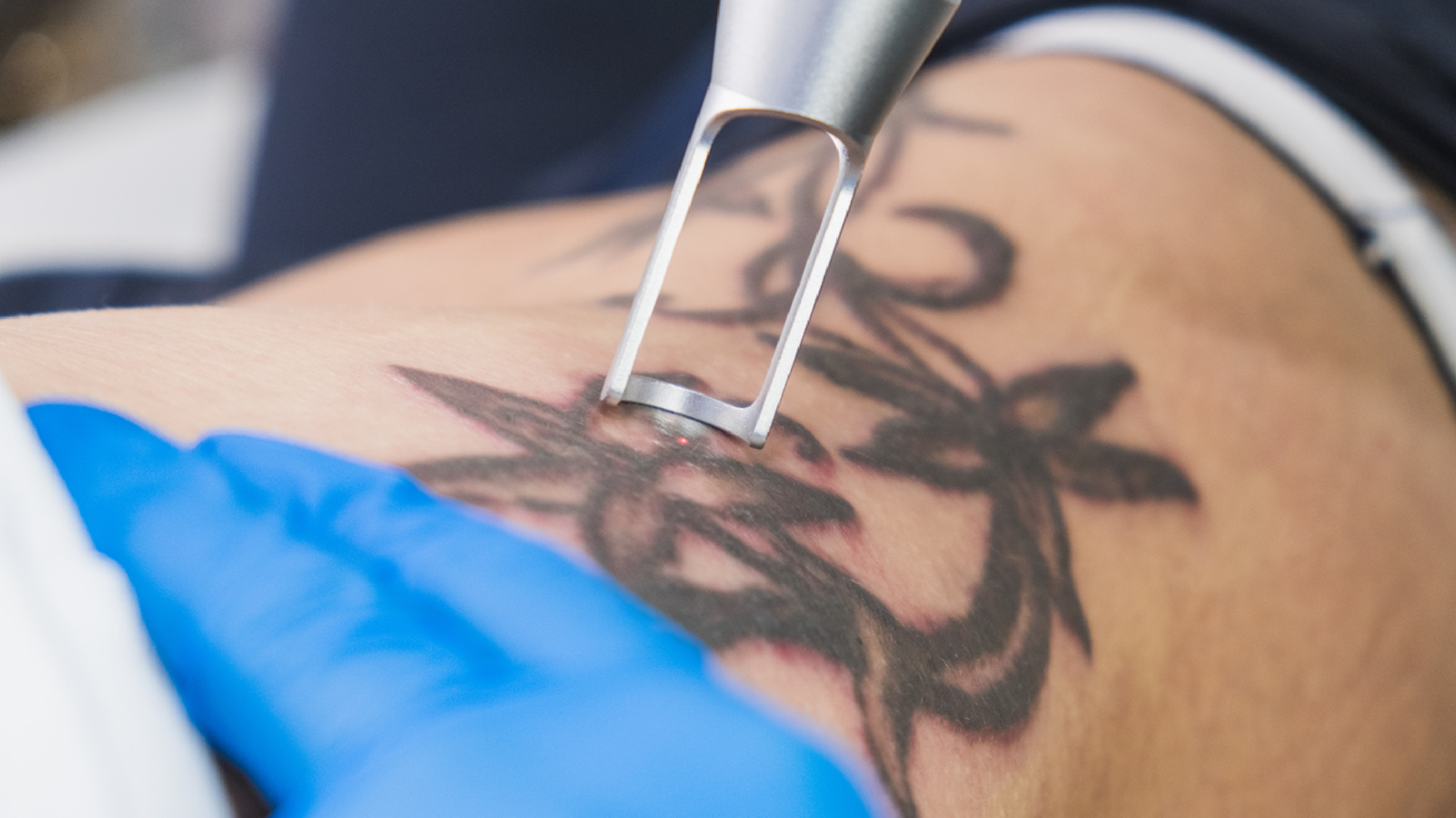 Laser Tattoo Removal